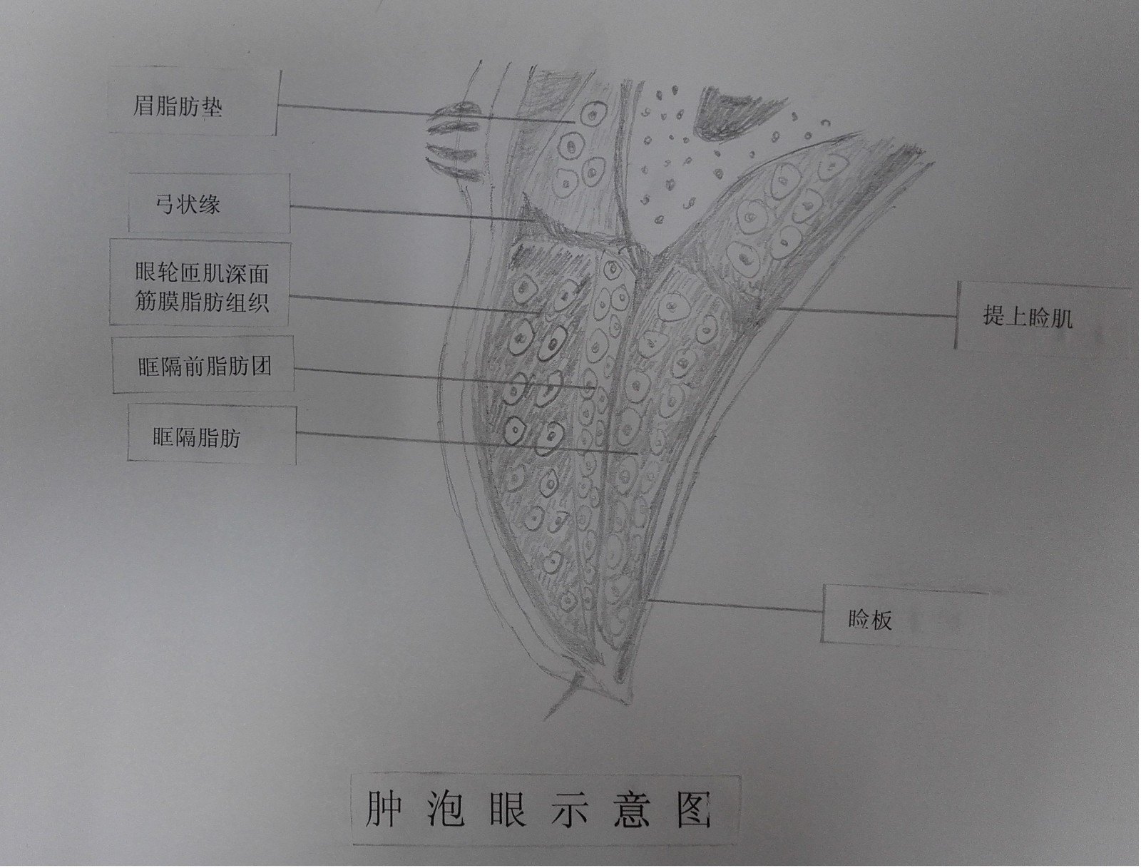眼轮匝肌深面筋膜脂肪组织的解剖及在肿泡眼整复中的意义