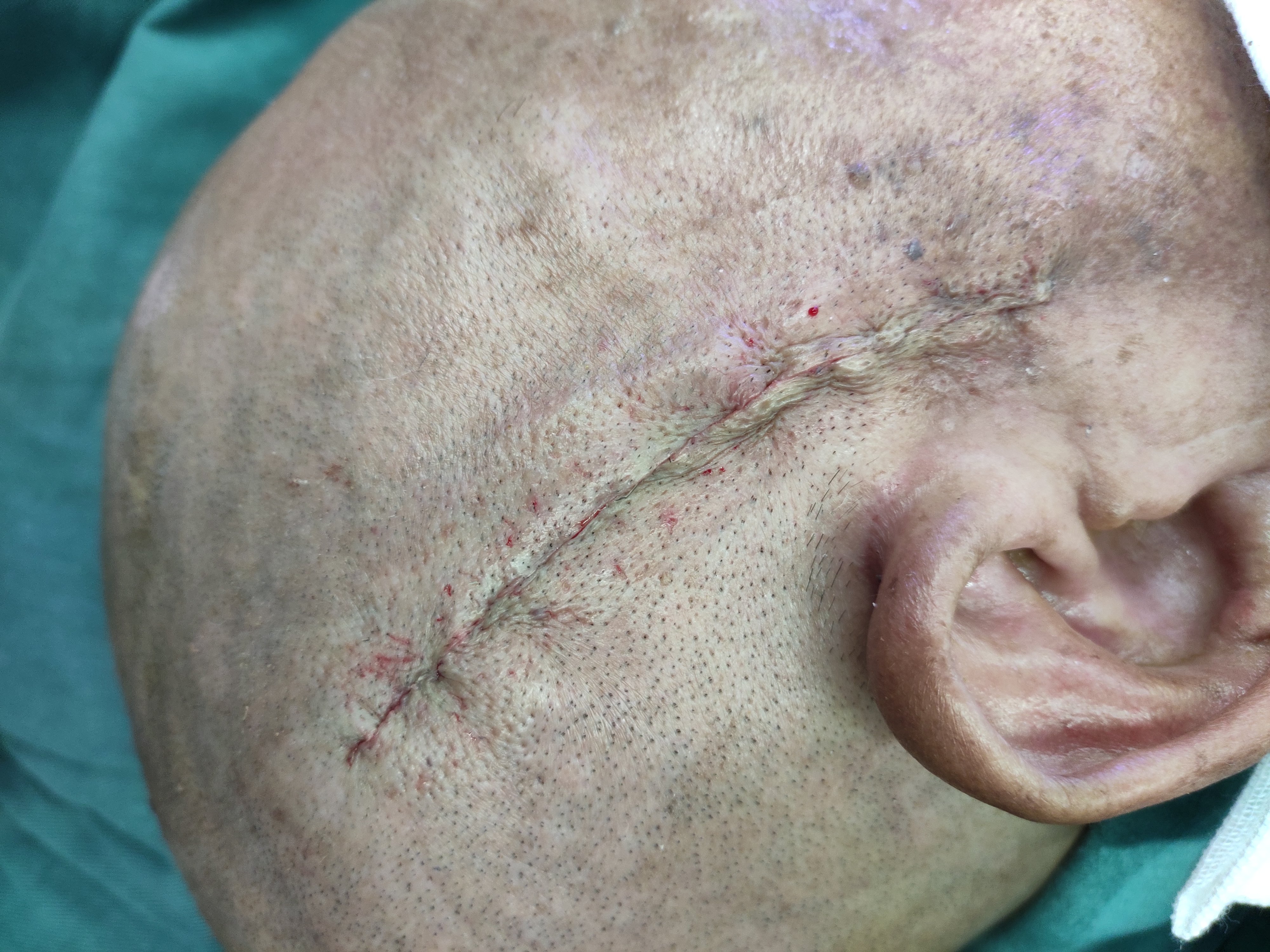头部微创手术伤口图片图片