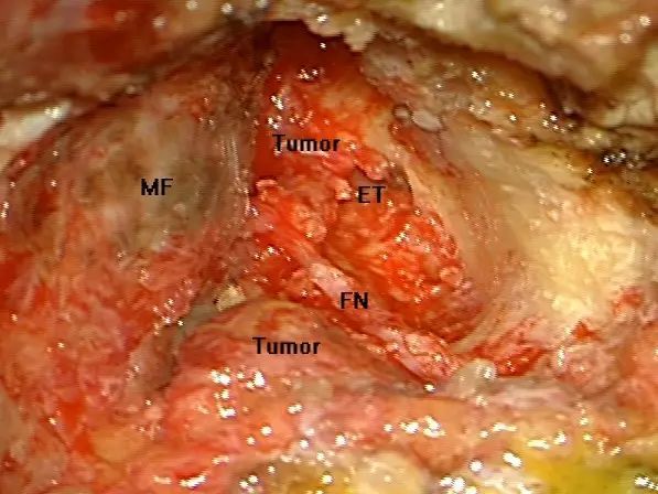 侧颅底巨大面神经瘤:颞骨近全切除_面神经瘤_症状表现_治疗方式 - 好