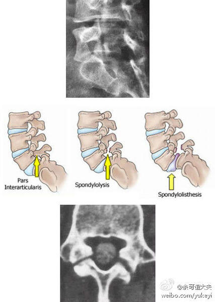 图解腰椎峡部裂是怎么回事?