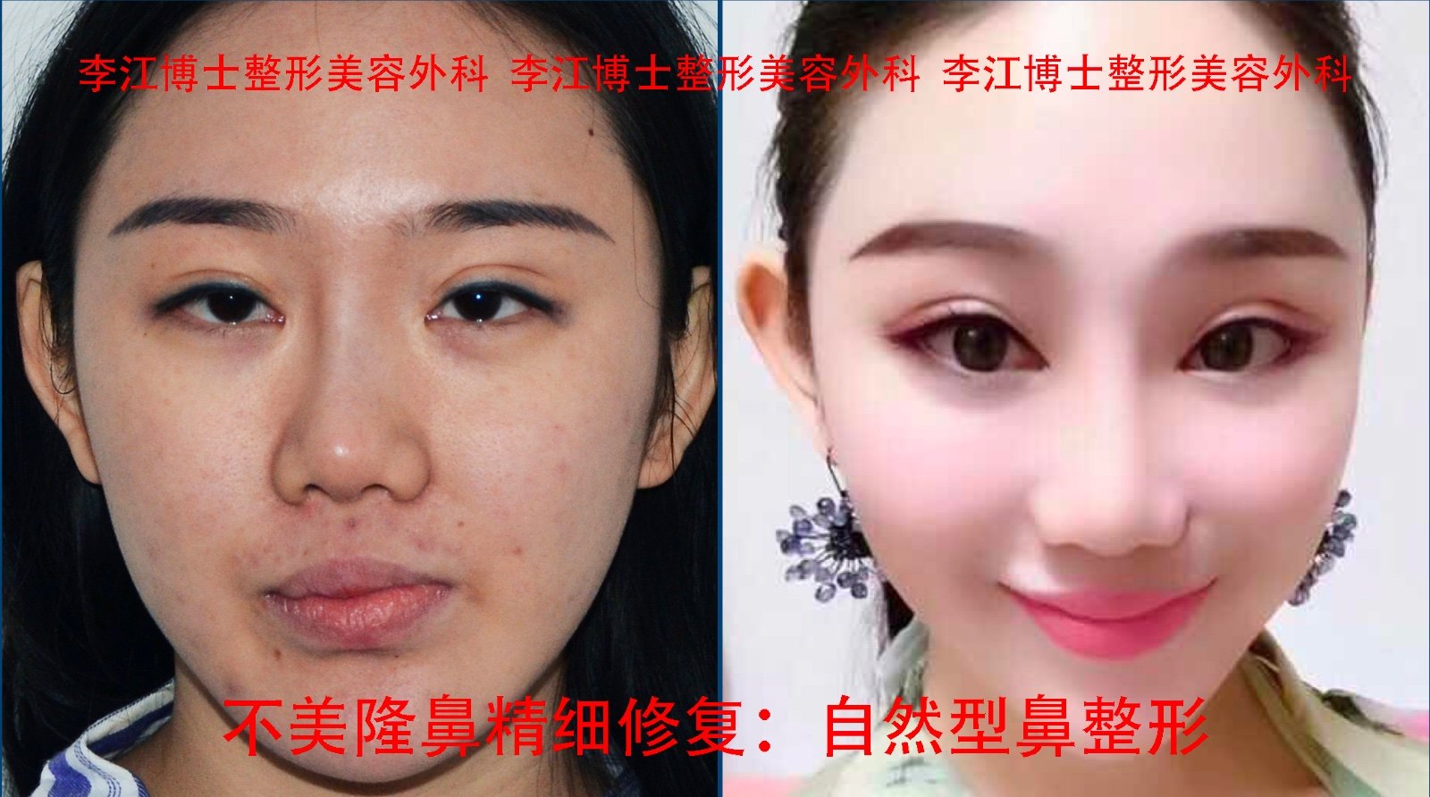 隆鼻修复 鼻综合修复 拯救被毁的鼻子 多彩图ok 鼻整形修复 隆鼻修复 鼻综合修复 拯救被毁的鼻子 多彩图ok 鼻整形修复