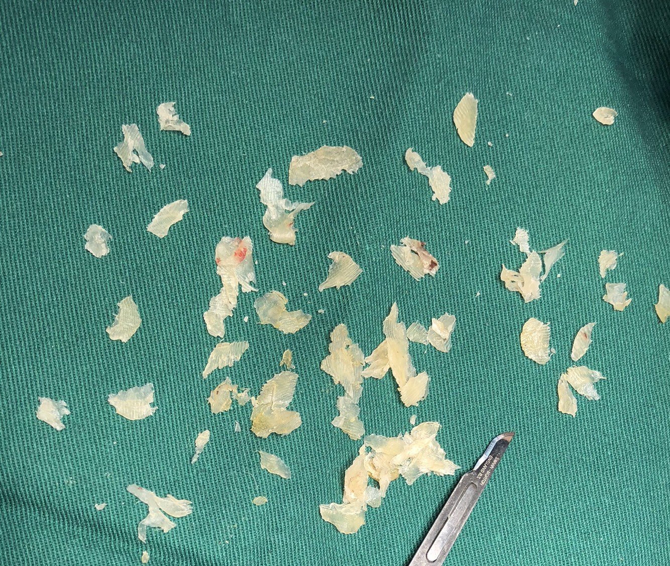 跖疣治疗(削切联合水杨酸治疗)