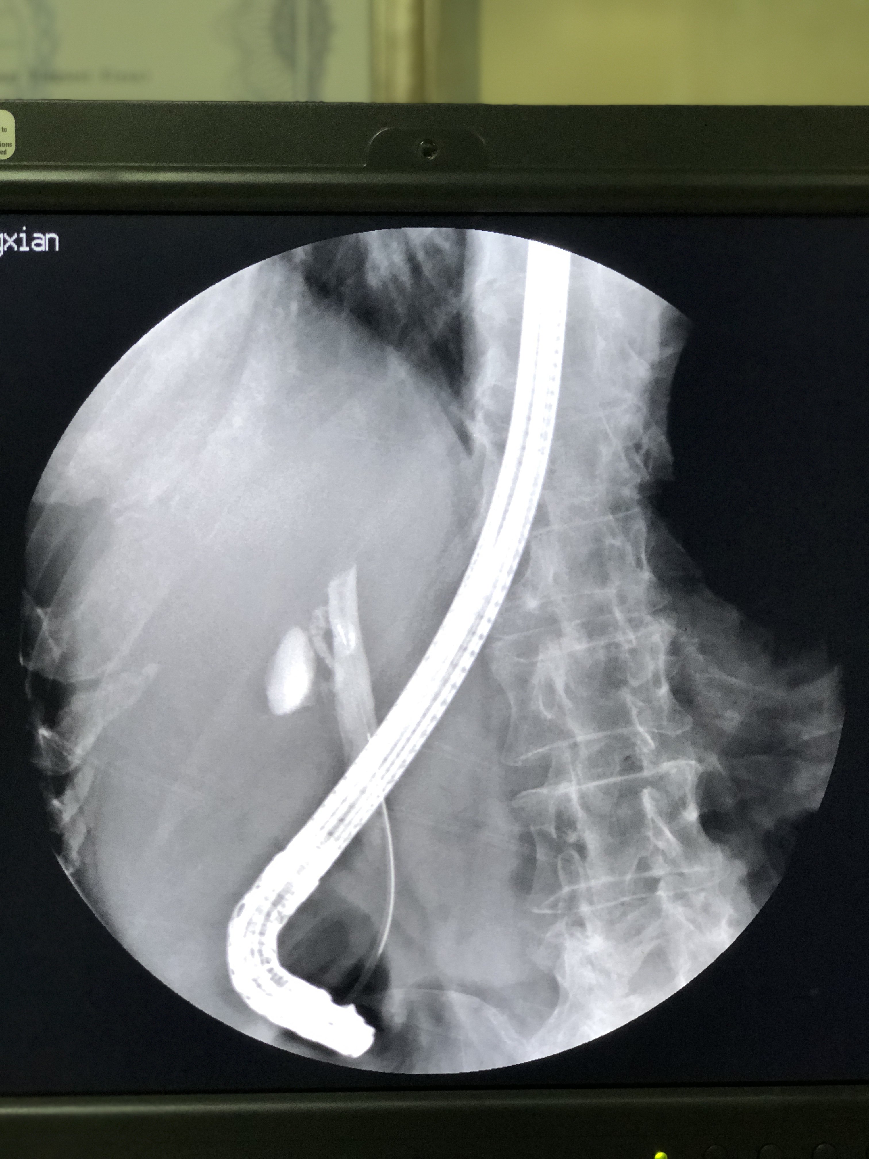 胆管支架手术图片