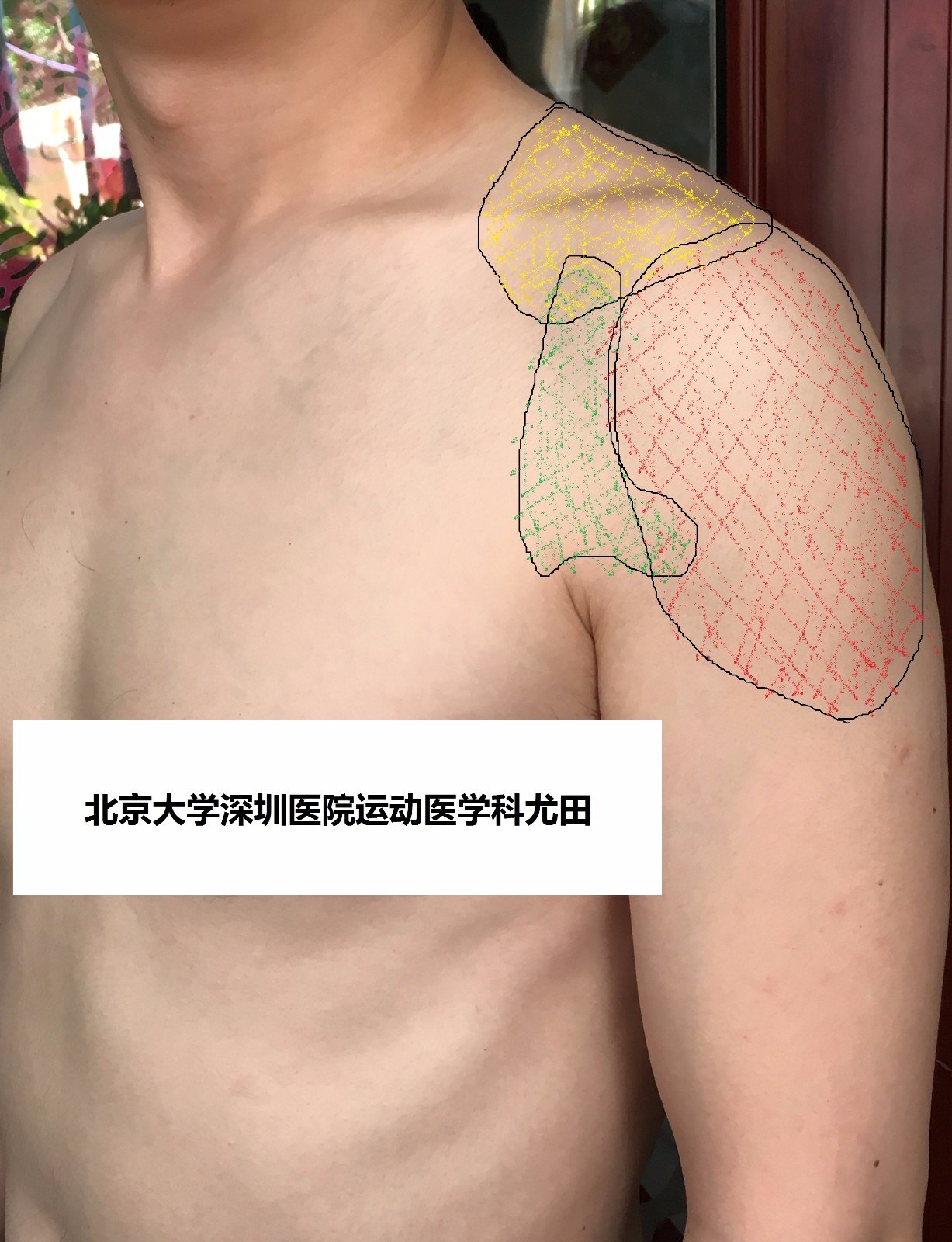 尤大夫教您一分钟快速诊断肩关节痛 肩关节损伤 肩关节损伤病因 尤大夫教您一分钟快速诊断肩关节痛 肩关节损伤 肩关节损伤病因