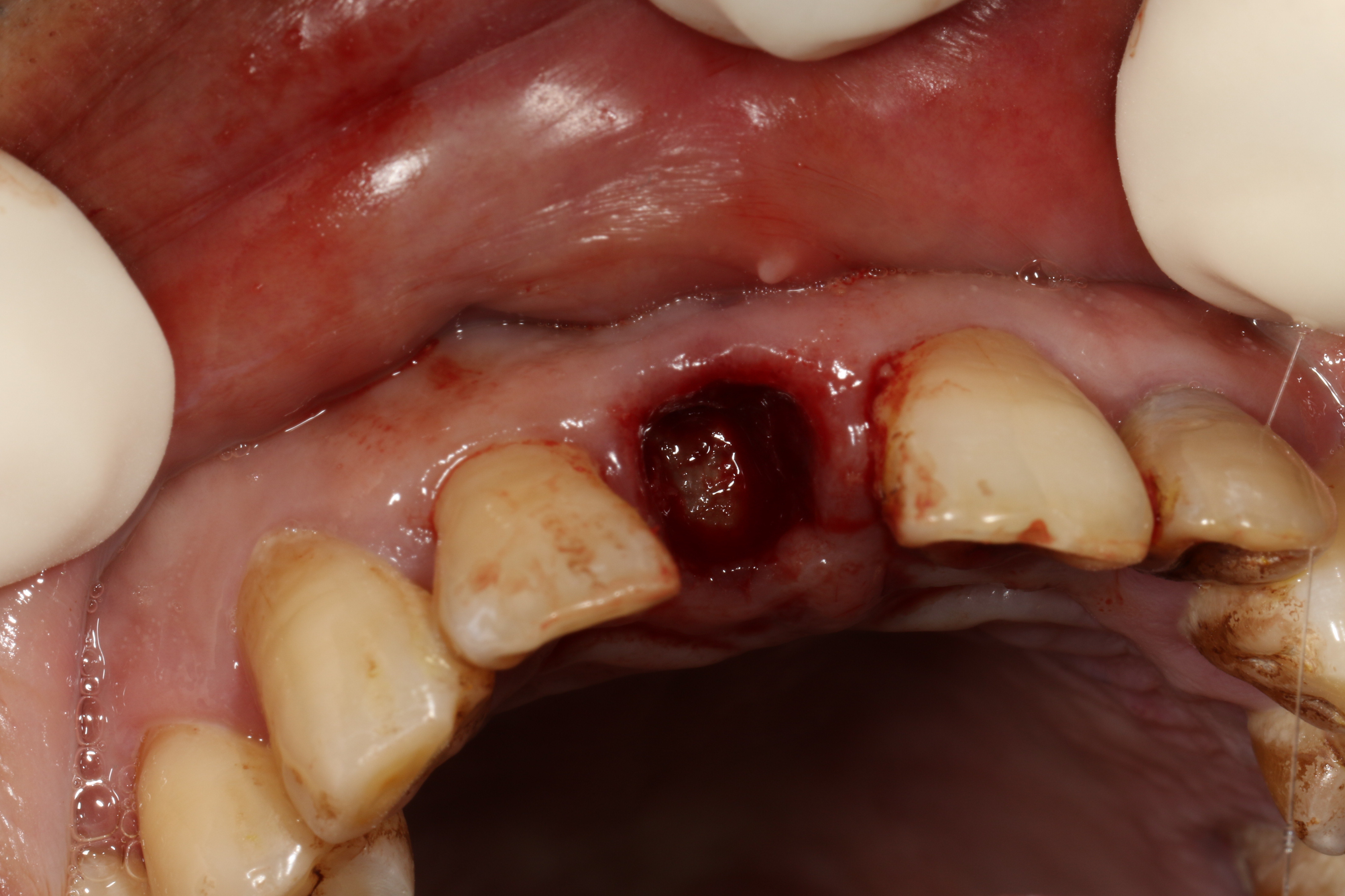 前牙根部折断后的迅速牙再生 