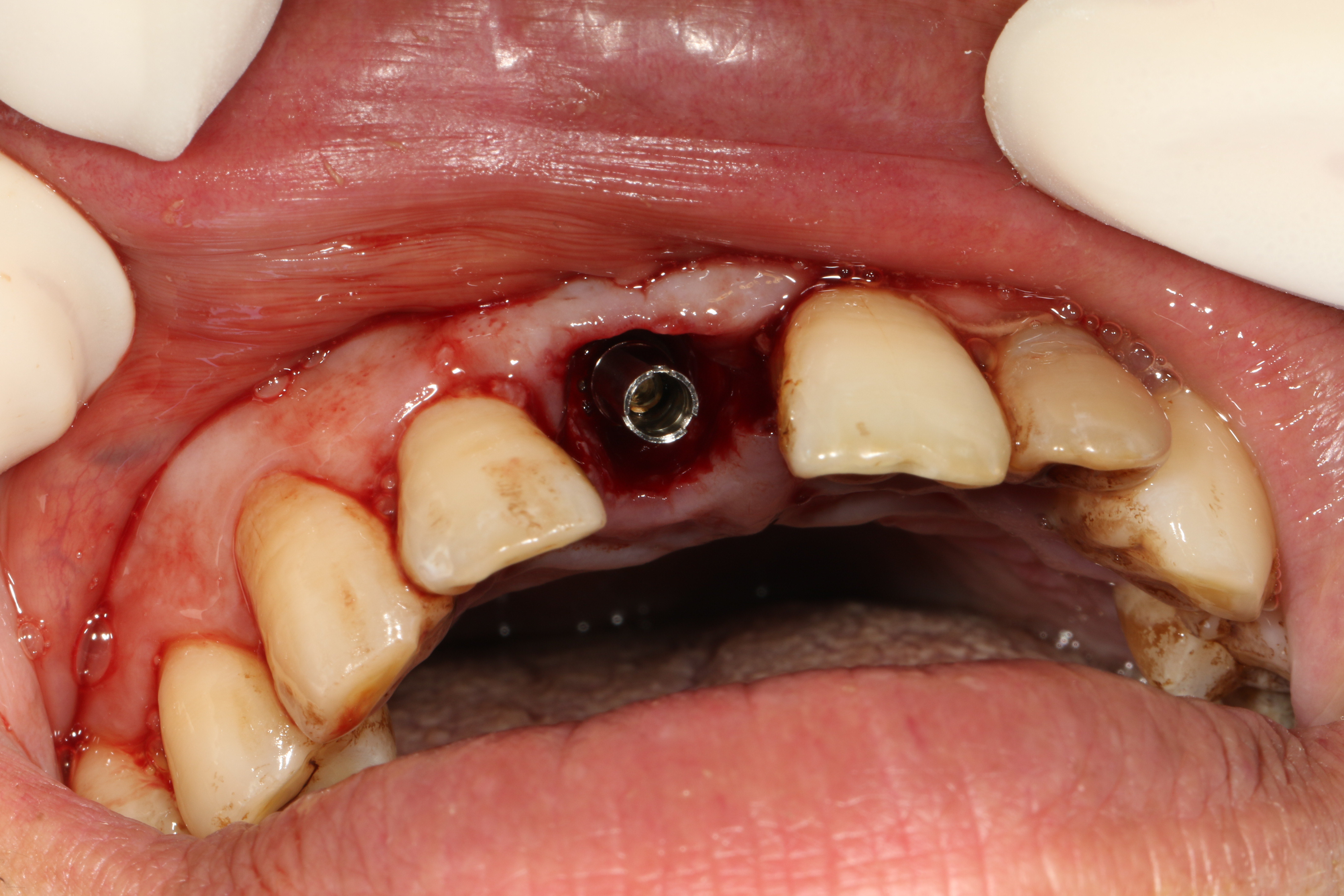前牙根部折断后的迅速牙再生 