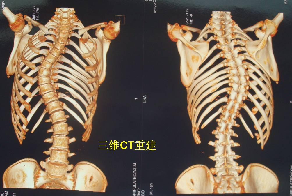 脊柱侧弯典型病例7