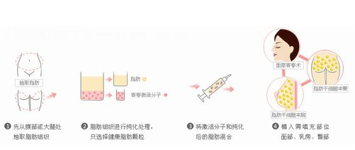 面部脂肪填充(脂肪干细胞胶注射)--面部年轻化