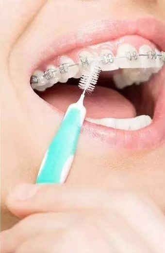 【暑期正畸十讲之四—正畸更要好好刷牙】 - 好大夫在线