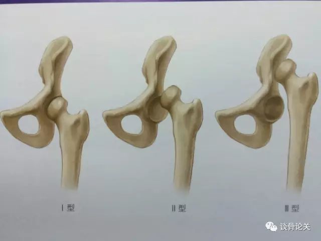 图10  髋臼发育不良示意图图11髋臼发育不良正,蛙,全长片4,强直性脊柱