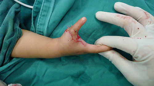 拇指发育不良三节拇治疗示指拇化术