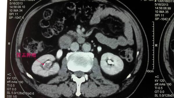 腹腔鏡腎輸尿管全長切除術