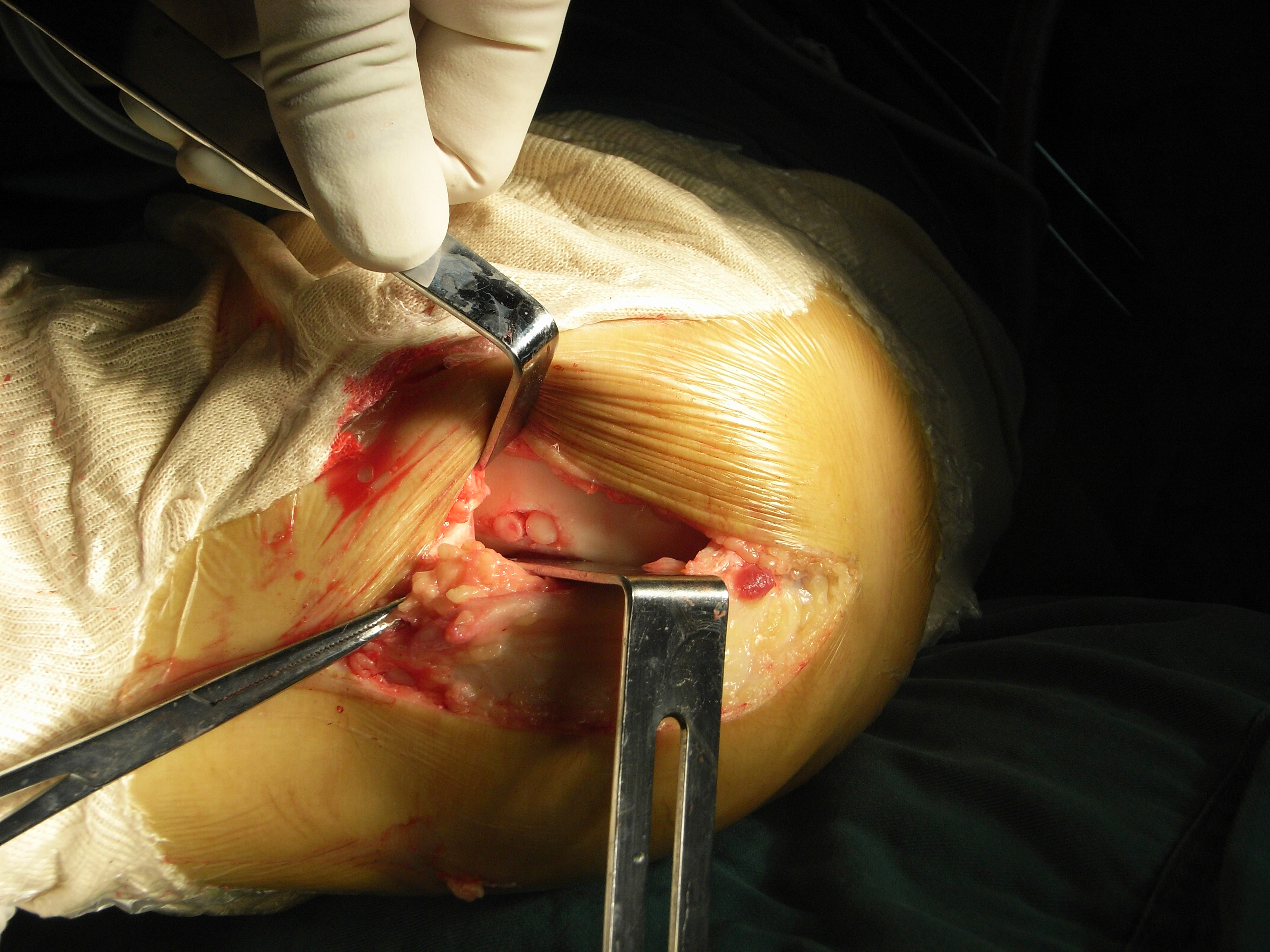 马赛克技术治疗关节软骨损伤 - 好大夫在线