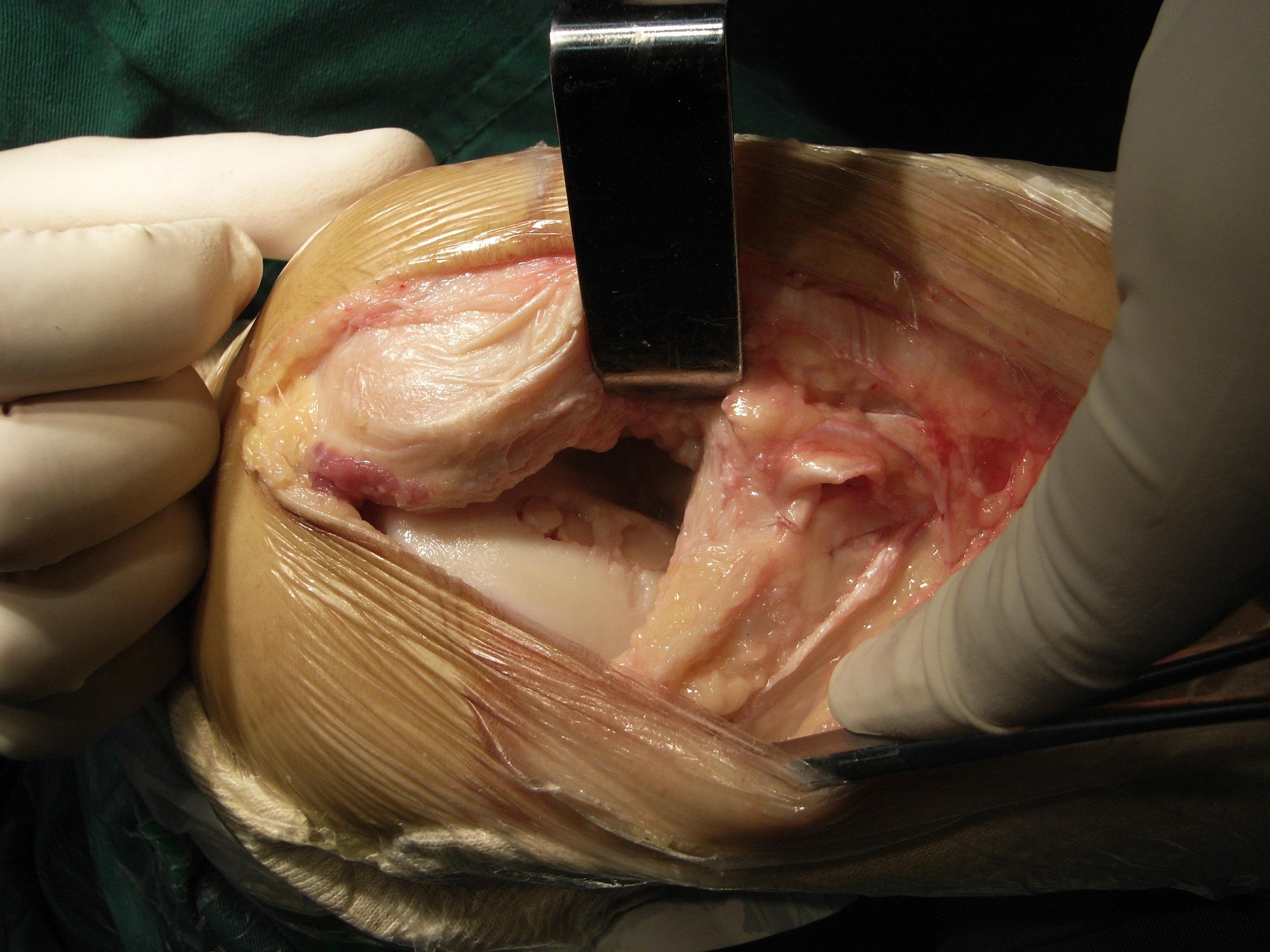 马赛克技术治疗关节软骨损伤 - 好大夫在线