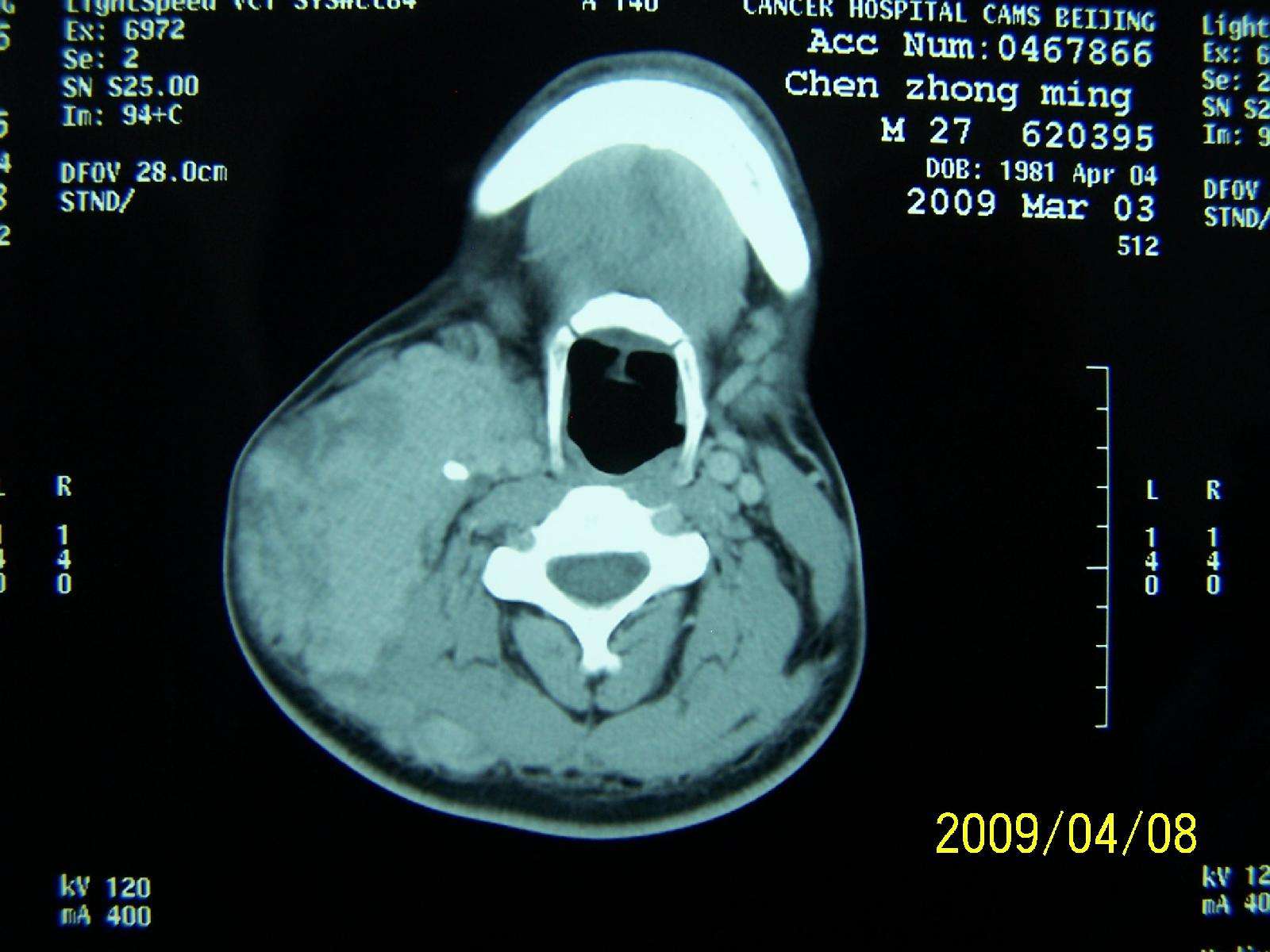 病例6-57 黏液性囊腺瘤(1)-临床医学-医学