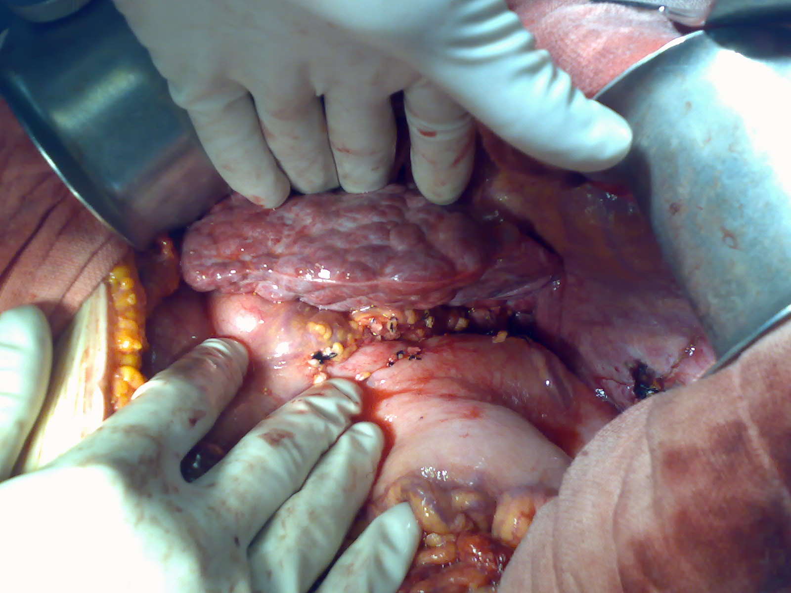 肝移植的常见适应症——肝炎后肝硬化