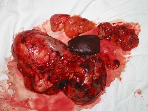 腹膜脂肪瘤图片
