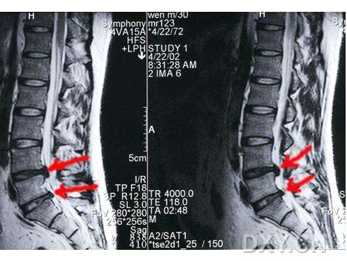 腰椎核磁解剖图谱图片