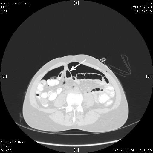气腹造影原理 正常腹腔ct及肠粘连的表现