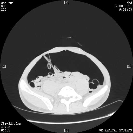 气腹造影原理 正常腹腔ct及肠粘连的表现 - 好大夫在线