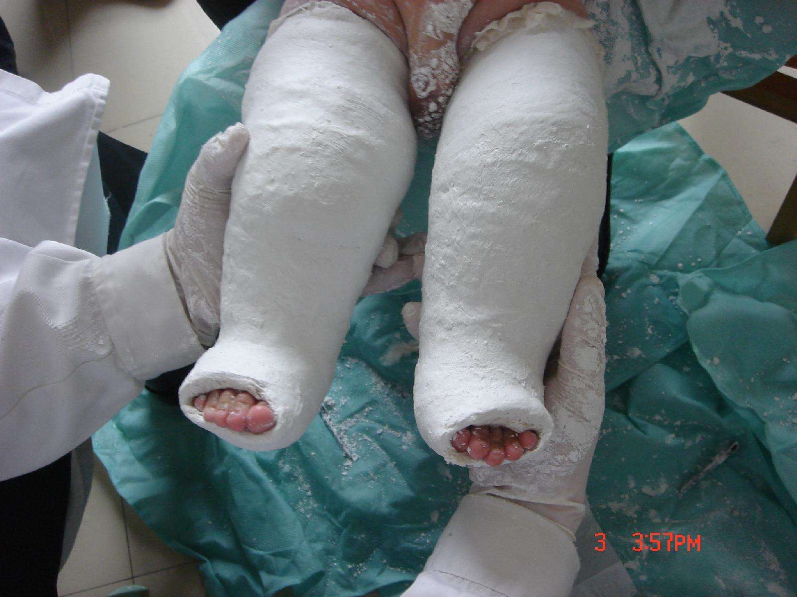 介绍一种儿童常见畸形—马蹄内翻足