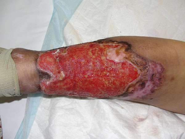 同一患者,入院后两周,经局部抗菌换药,创面整洁,肉芽新鲜.