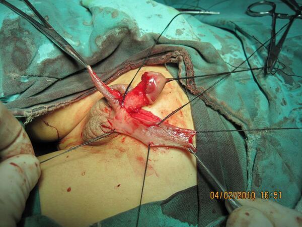 尿道下裂手术前后图片图片