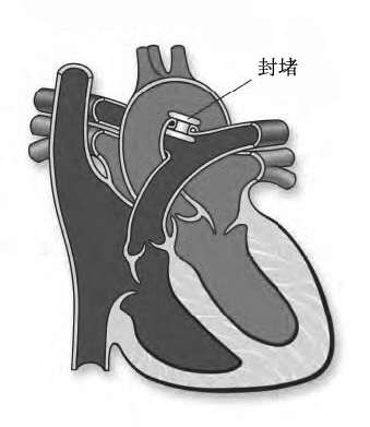 先天性心脏病动脉导管未闭简介