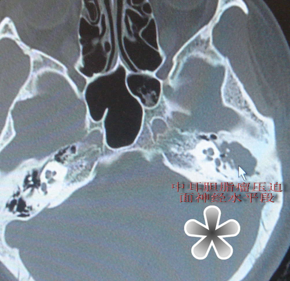 危險型中耳炎- 膽脂瘤壓迫面神經致面癱,手術治癒
