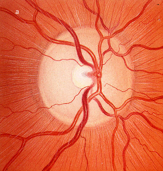 b 病理性杯盘比a 正常视神经杯(cup)盘(dish)比(c/d=0.