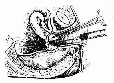 系将特制的内镜从阴道后穹窿置入子宫直肠陷凹内进行女性盆腔脏器的