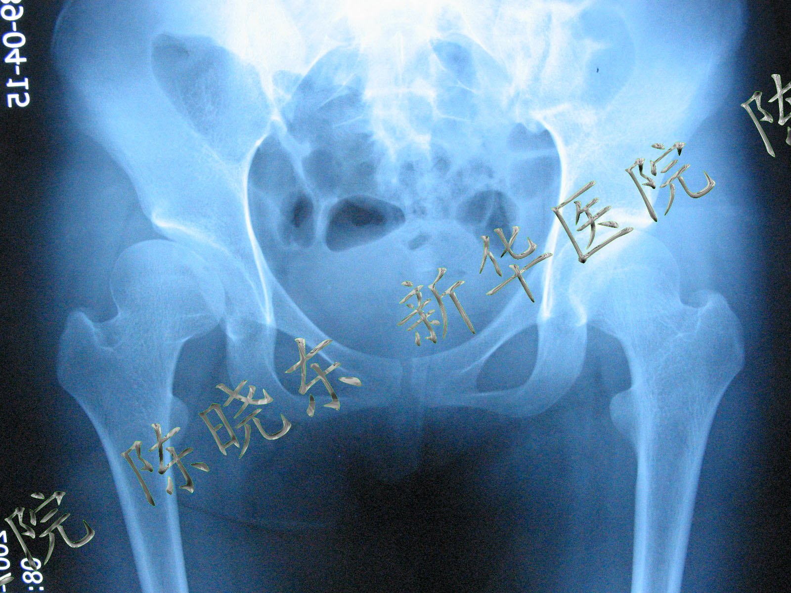 术前x线片显示髋关节半脱位,右侧股骨头有一半露在外面,没有被髋臼