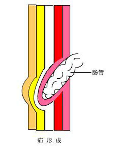 随时间推移,疝块逐渐增大,肌肉层缺损,其余各层向外膨出,肠管等进入疝