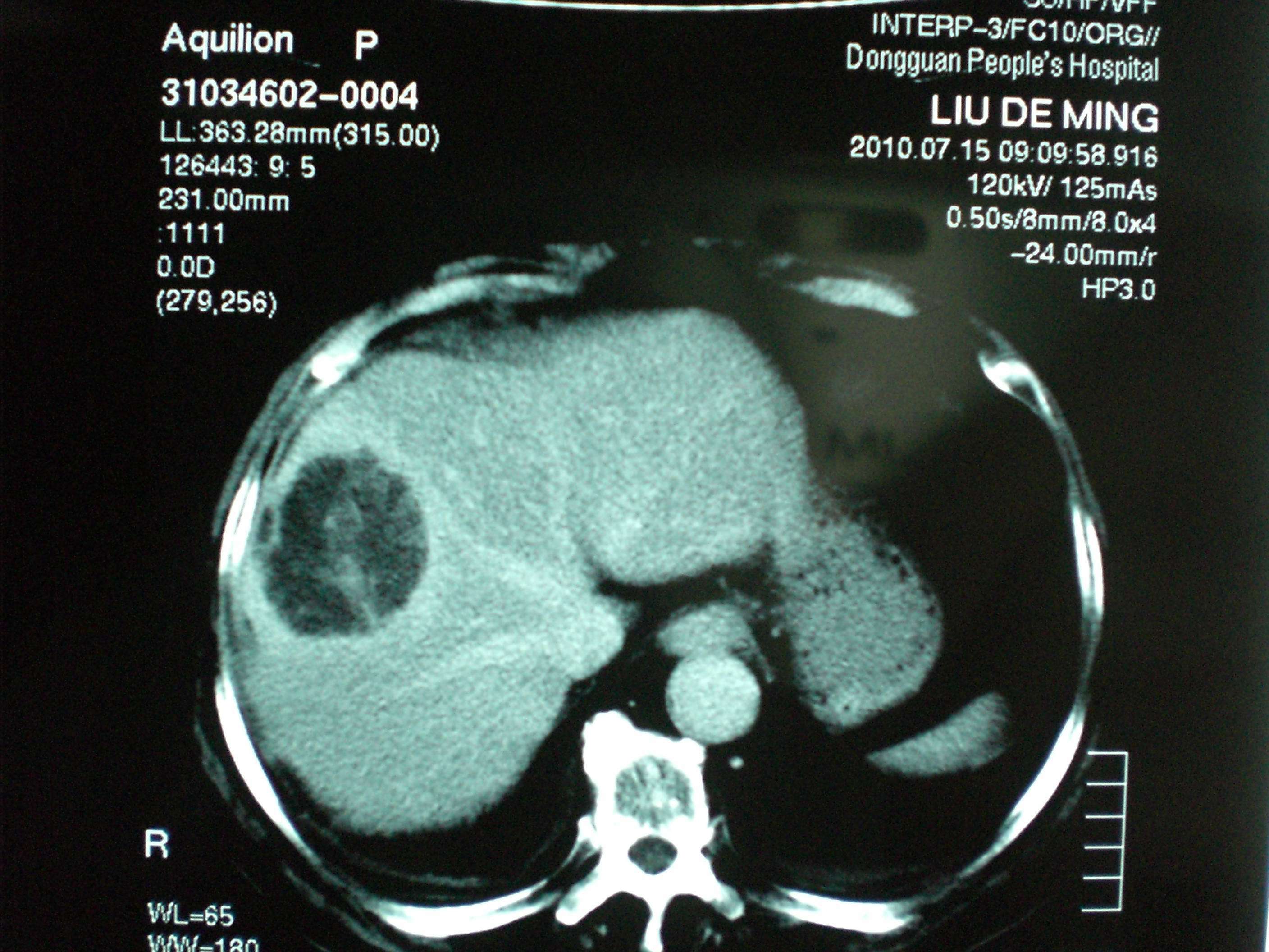 八旬高龄老人第8段巨大肝癌在肿瘤中心成功切除