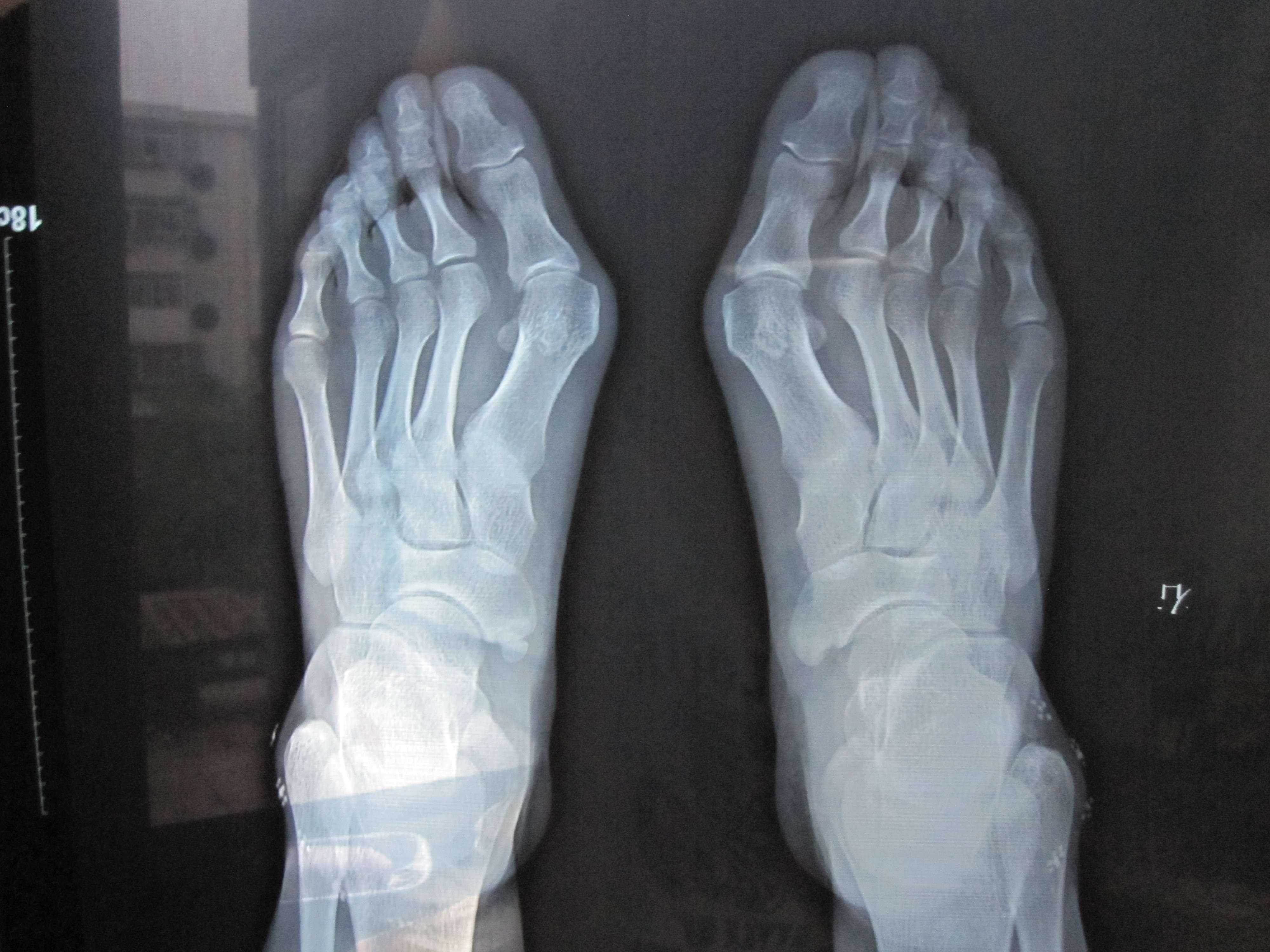 拇指外翻 平足 - 好大夫在线