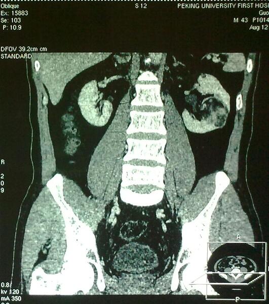 腹腔镜肾部分切除术高难度病例之8--错构瘤