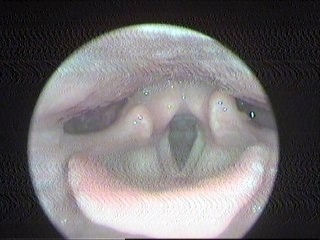该患者双声带新生物术后一周图