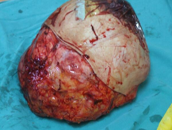 巨大乳腺纤维肉瘤 