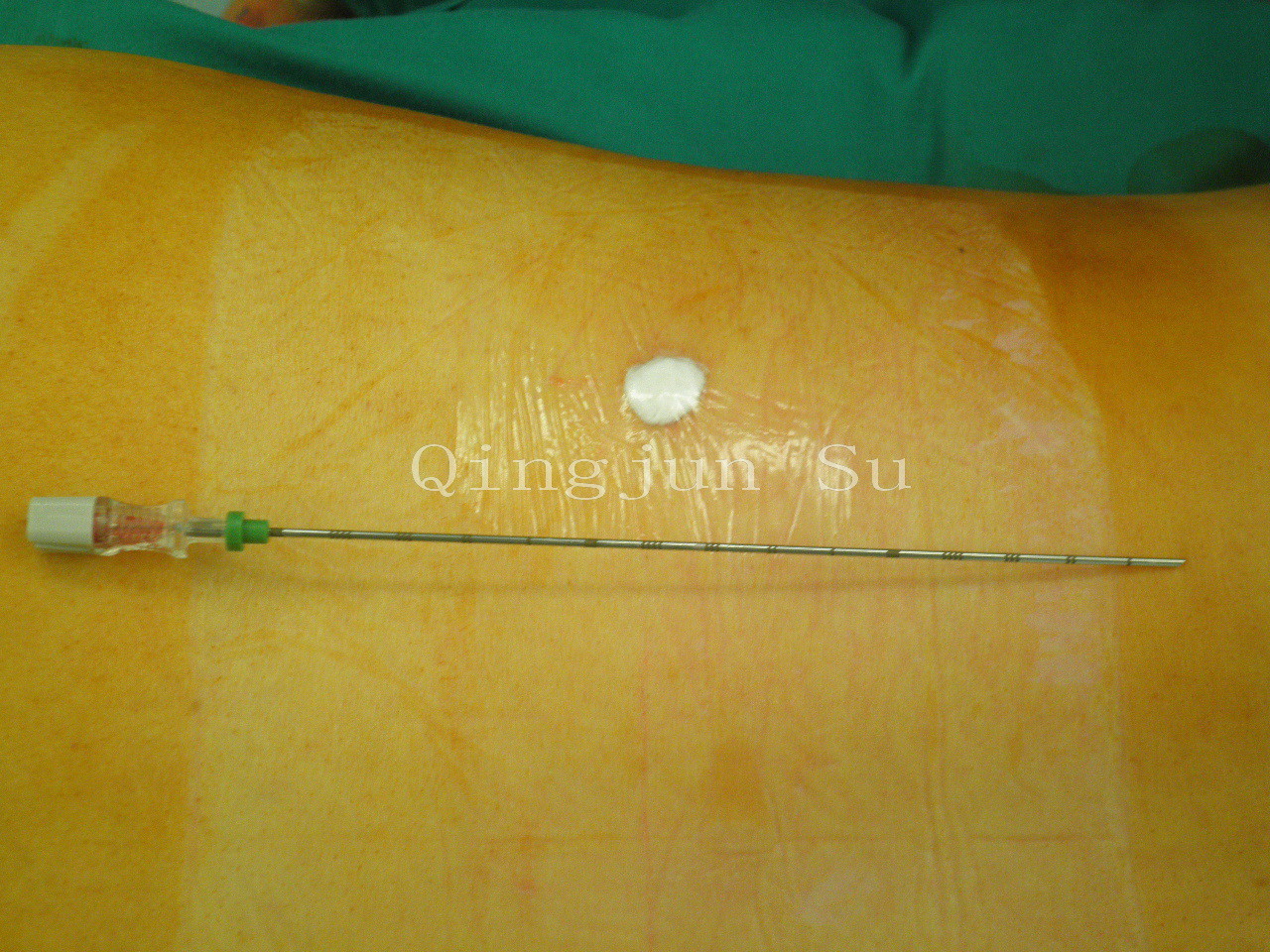 针图5 正在进行射频消融术图4 拔出针芯后经空心针插入射频消融针图3