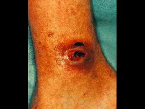 孢霉病是指由多种条件致病性棕色(暗色)真菌引起的皮下和深部组织感染