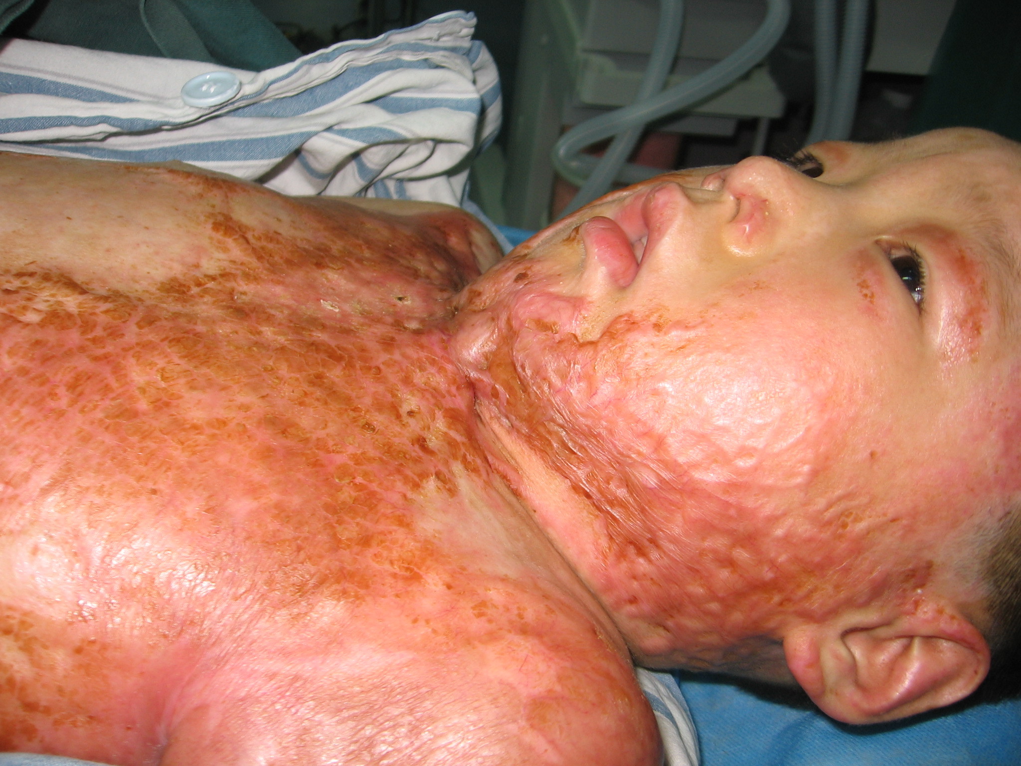 3,颈围护具锻炼2,松解植皮后,先颈部不能伸直.疤痕后大面积增生烧伤