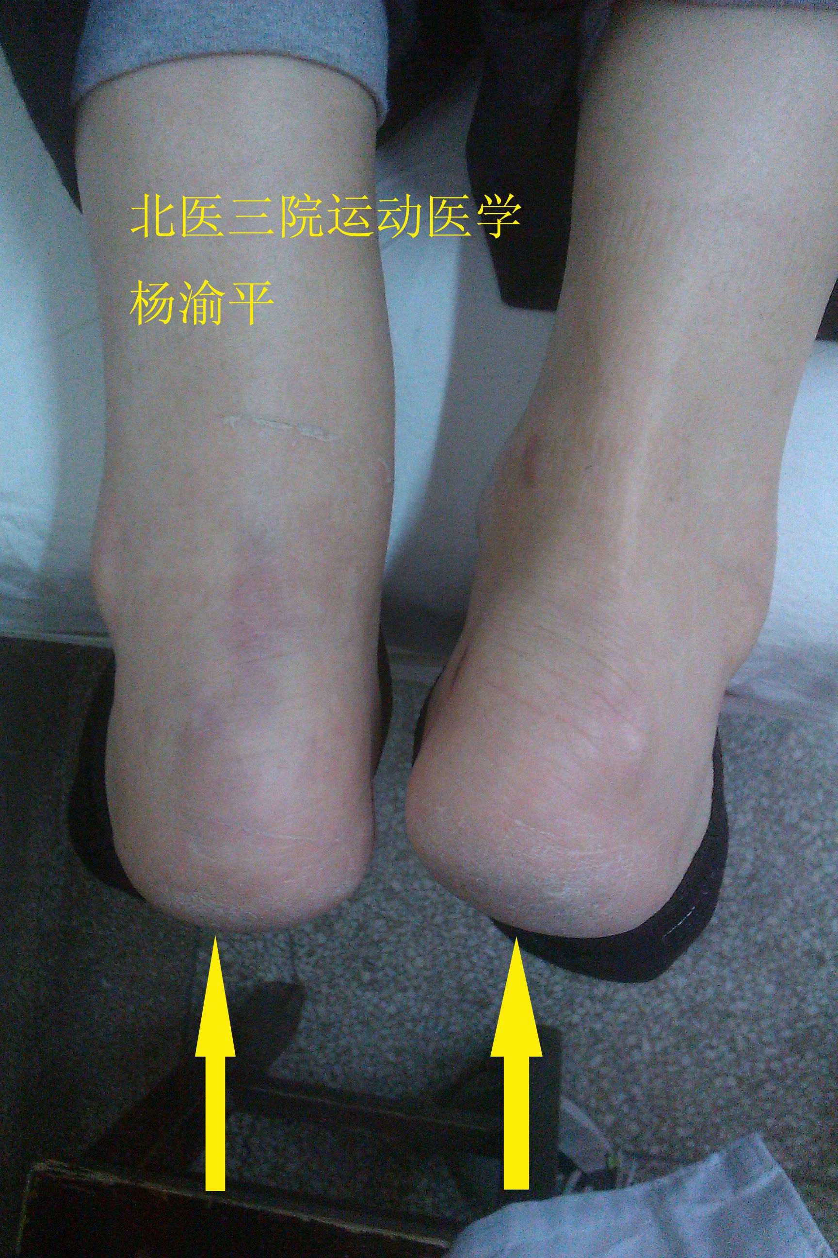 小心难治性跟腱断裂的发生!-北医三院运动医学研究所 杨渝平