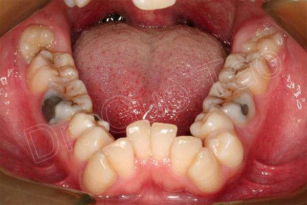 牙颌畸形_牙颌畸形疾病介绍 - 好大夫在线