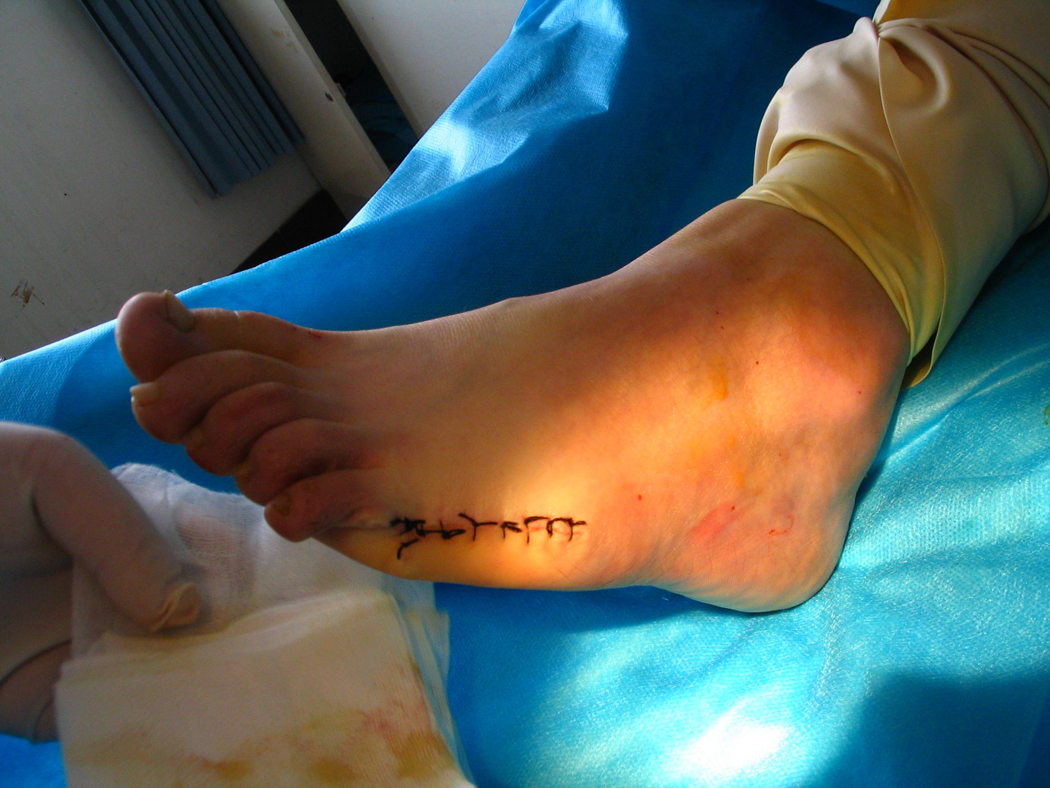 (图片)先天性手足多指(趾)畸形的外科治疗 - 好大夫在线