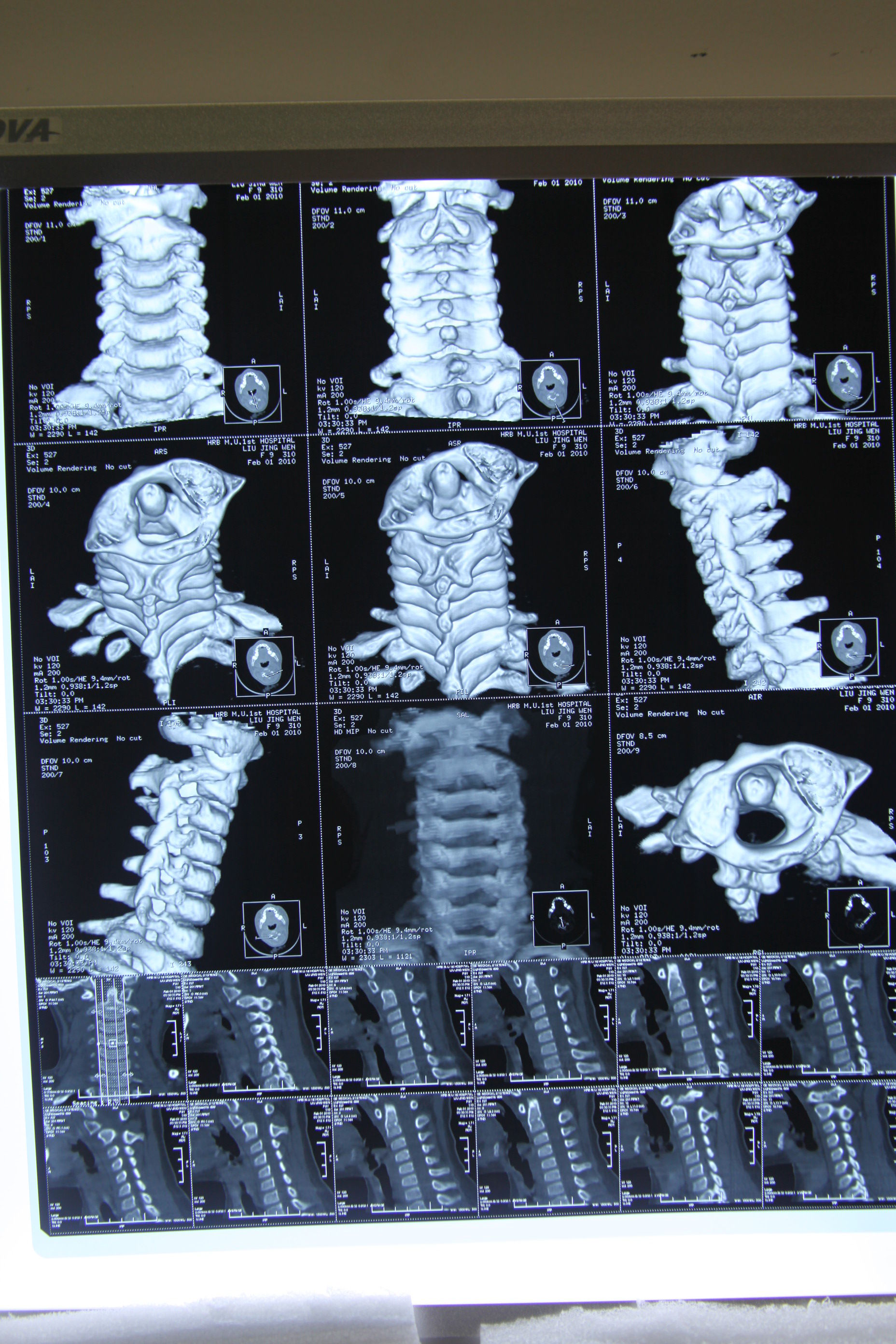 儿童寰枢椎不对称图图片