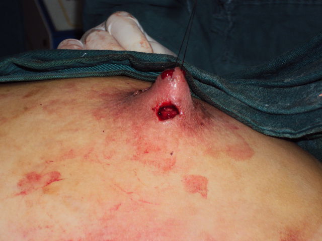 浆细胞性乳腺炎 手术图片