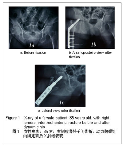 动力髁螺钉( dcs  : dynamic condyle screw )