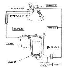 体外循环插管示意图图片