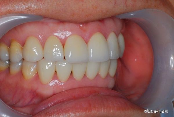 全瓷贴面 美学修复 旧树脂贴面变色、缺损!