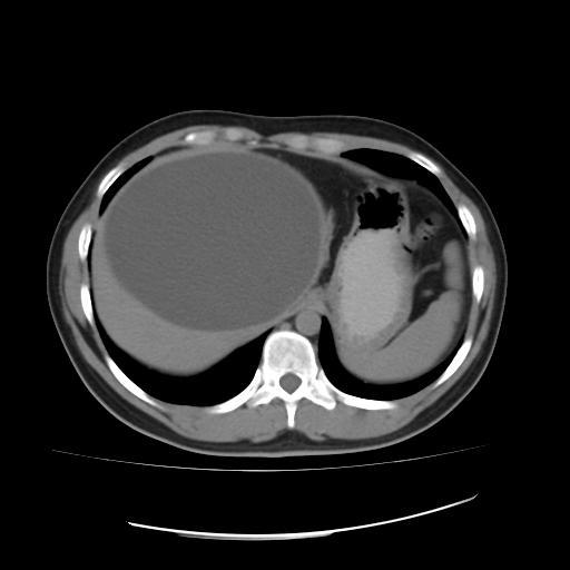 > 左石 > 文章列表 >单纯性肝包虫囊肿致术中过敏性休克1例  ct图片如